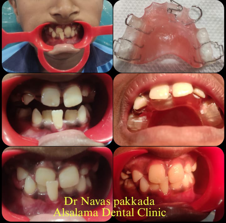 Anterior crossbite correction